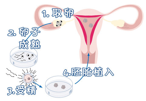 染色体易位